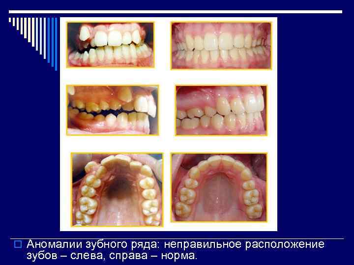 o Аномалии зубного ряда: неправильное расположение зубов – слева, справа – норма. 
