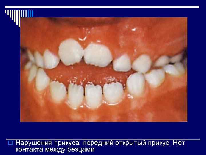 o Нарушения прикуса: передний открытый прикус. Нет контакта между резцами 