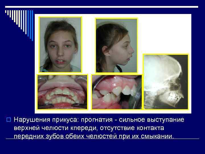 o Нарушения прикуса: прогнатия - сильное выступание верхней челюсти кпереди, отсутствие контакта передних зубов
