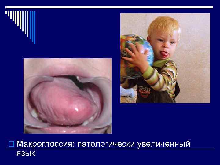 o Макроглоссия: патологически увеличенный язык 