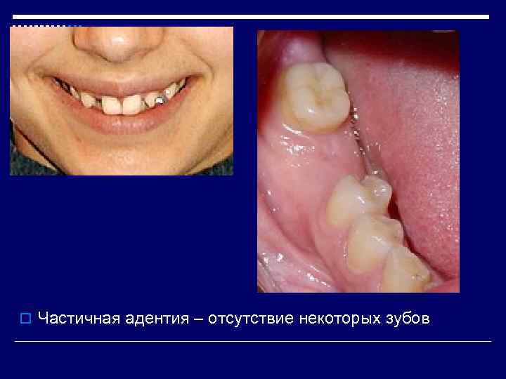 o Частичная адентия – отсутствие некоторых зубов 