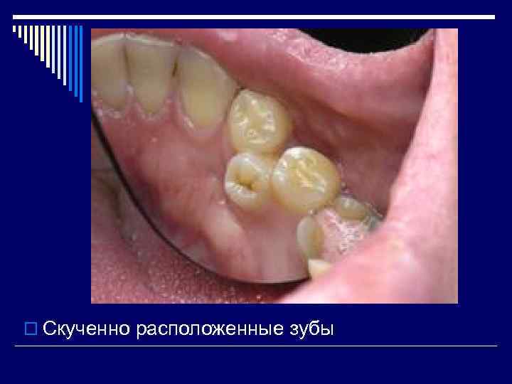 o Скученно расположенные зубы 