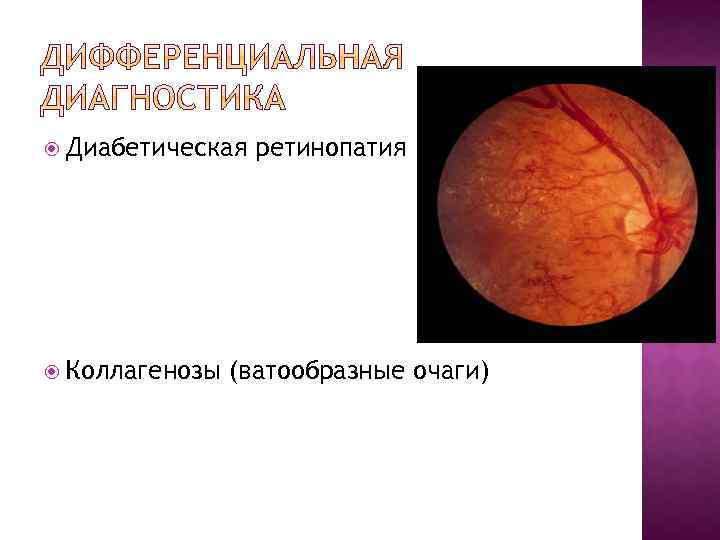  Диабетическая Коллагенозы ретинопатия (ватообразные очаги) 