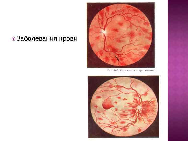  Заболевания крови 