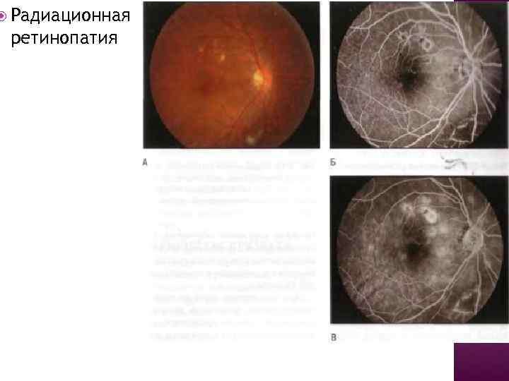  Радиационная ретинопатия 