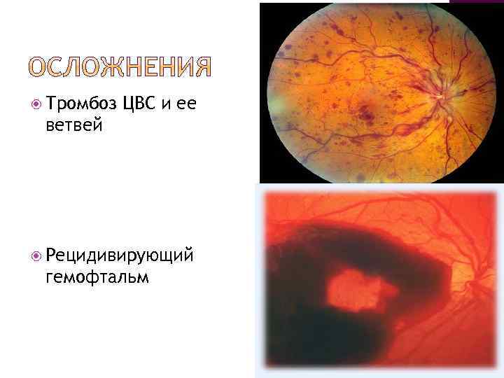  Тромбоз ЦВС и ее ветвей Рецидивирующий гемофтальм 