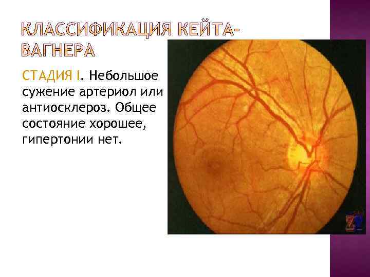 СТАДИЯ I. Небольшое сужение артериол или антиосклероз. Общее состояние хорошее, гипертонии нет. 