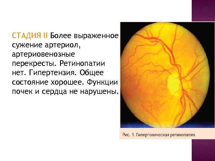 Гипертоническая ретинопатия презентация