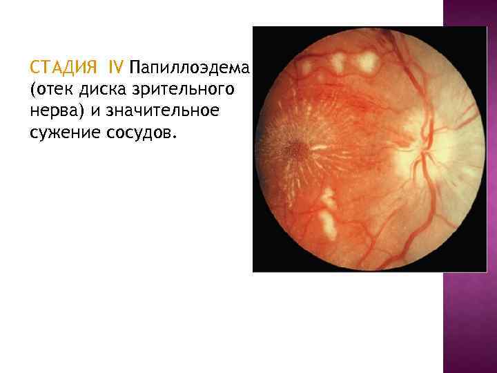 СТАДИЯ IV Папиллоэдема (отек диска зрительного нерва) и значительное сужение сосудов. 