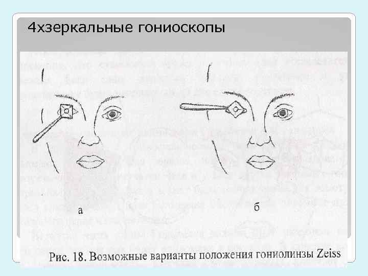 4 хзеркальные гониоскопы 