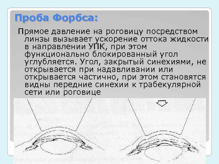 Проба Форбса: Прямое давление на роговицу посредством линзы вызывает ускорение оттока жидкости в направлении