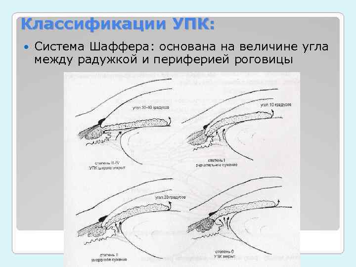 Классификации УПК: Система Шаффера: основана на величине угла между радужкой и периферией роговицы 