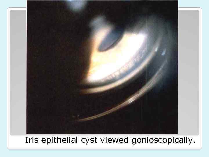 Iris epithelial cyst viewed gonioscopically. 