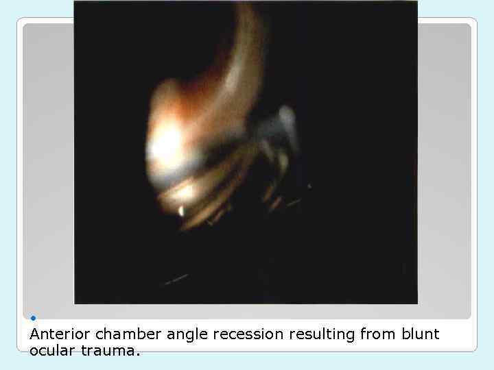  Anterior chamber angle recession resulting from blunt ocular trauma. 