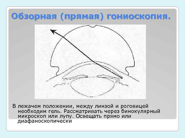 Обзорная (прямая) гониоскопия. В лежачем положении, между линзой и роговицей необходим гель. Рассматривать через