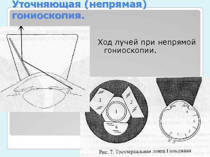 Уточняющая (непрямая) гониоскопия. Ход лучей при непрямой гониоскопии. 
