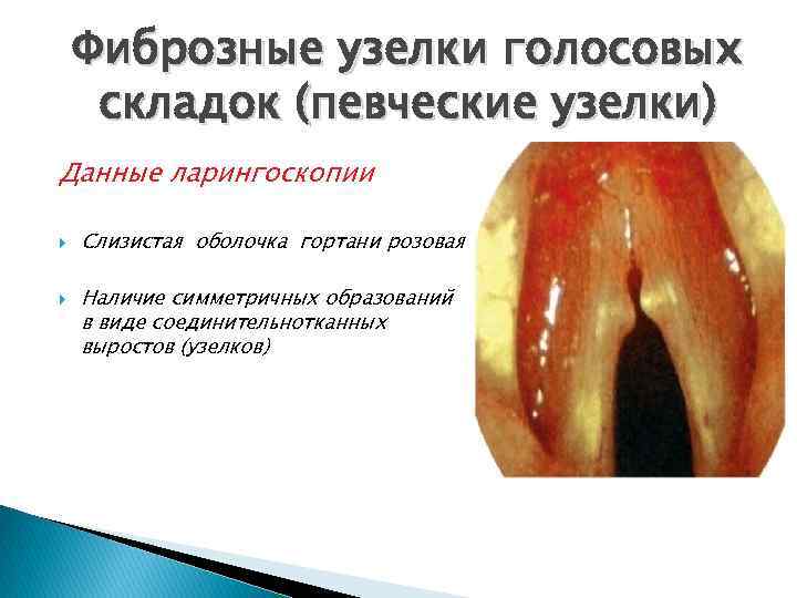 Фиброзные узелки голосовых складок (певческие узелки) Данные ларингоскопии Слизистая оболочка гортани розовая Наличие симметричных