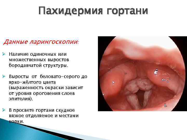 Пахидермия гортани Данные ларингоскопии: Ø Наличие одиночных или множественных выростов бородавчатой структуры. Ø Выросты