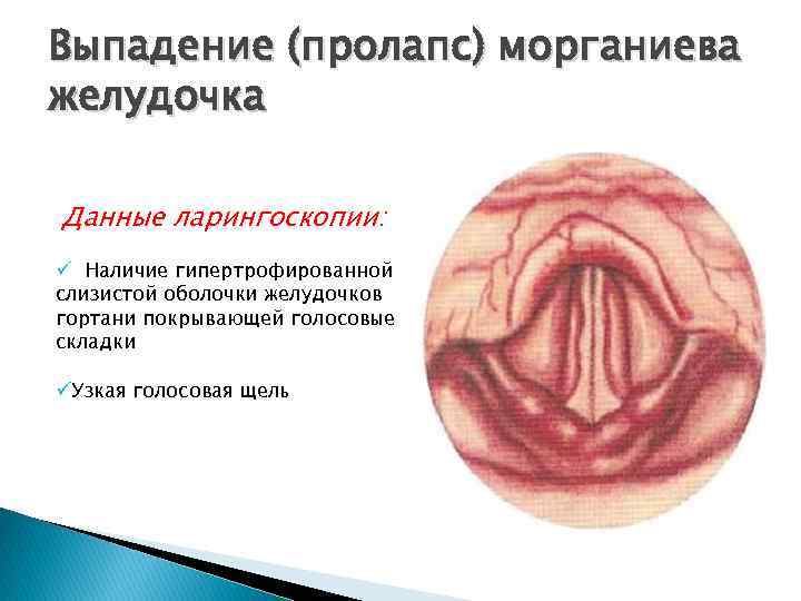 Выпадение (пролапс) морганиева желудочка Данные ларингоскопии: ü Наличие гипертрофированной слизистой оболочки желудочков гортани покрывающей