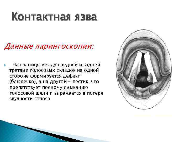 Контактная язва Данные ларингоскопии: На границе между средней и задней третями голосовых складок на