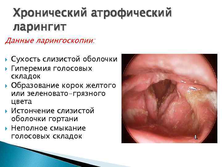 Хронический атрофический ларингит Данные ларингоскопии: Сухость слизистой оболочки Гиперемия голосовых складок Образование корок желтого