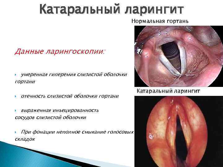 Катаральный ларингит Нормальная гортань Данные ларингоскопии: умеренная гиперемия слизистой оболочки гортани отечность слизистой оболочки