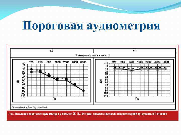 Пороговая аудиометрия 