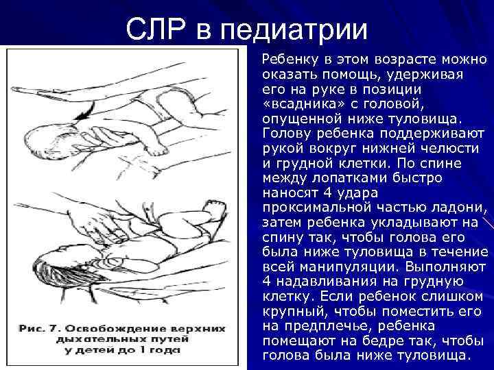 Время сердечной легочной реанимации