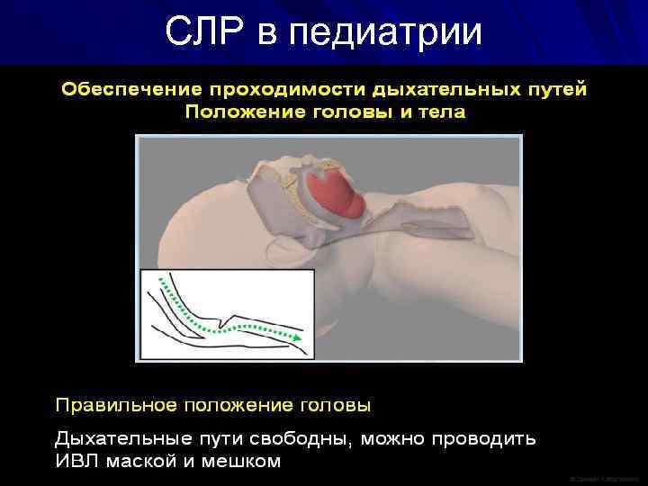 СЛР в педиатрии 