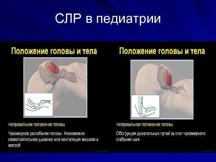 СЛР в педиатрии 