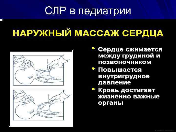 СЛР в педиатрии 