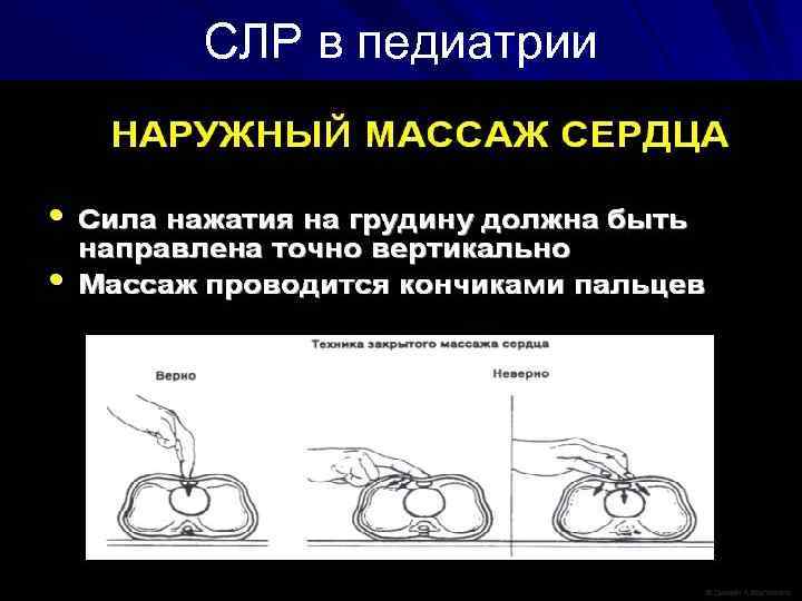 СЛР в педиатрии 