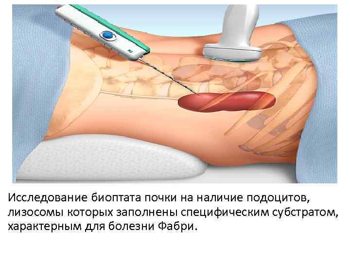 Исследование биоптата почки на наличие подоцитов, лизосомы которых заполнены специфическим субстратом, характерным для болезни