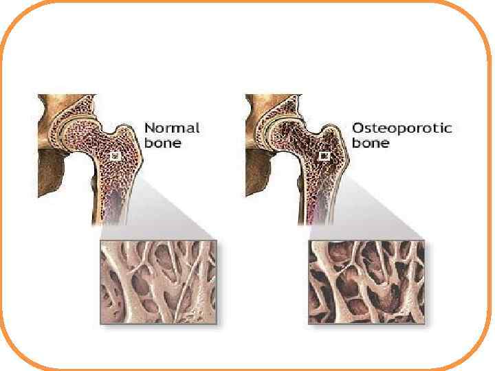Остеопороз бедренной кости 