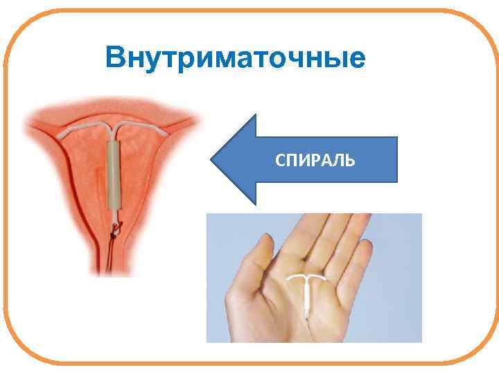 Внутриматочные СПИРАЛЬ 