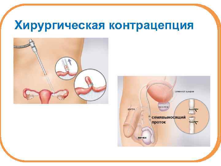 Хирургическая контрацепция 