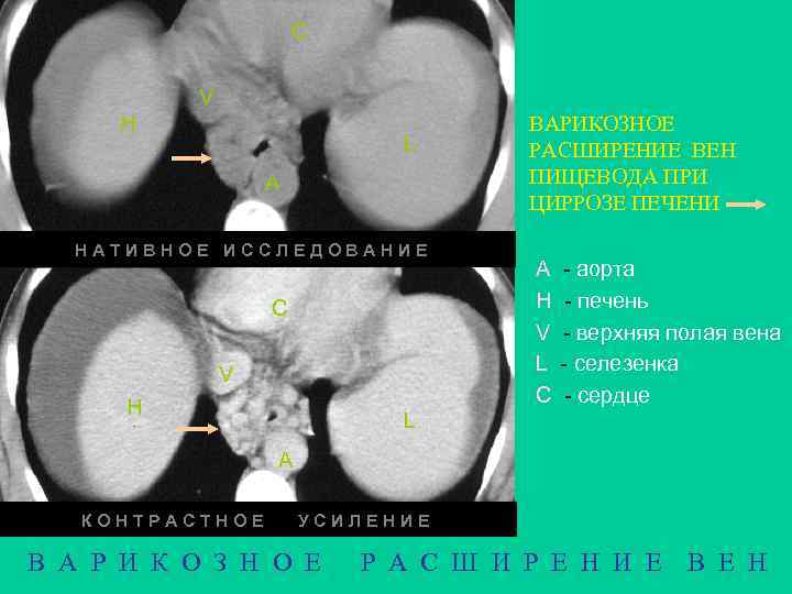 С V Н L А НАТИВНОЕ ИССЛЕДОВАНИЕ С V Н ВАРИКОЗНОЕ РАСШИРЕНИЕ ВЕН ПИЩЕВОДА