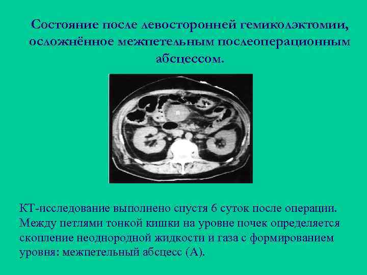 Состояние после левосторонней гемиколэктомии, осложнённое межпетельным послеоперационным абсцессом. КТ-исследование выполнено спустя 6 суток после