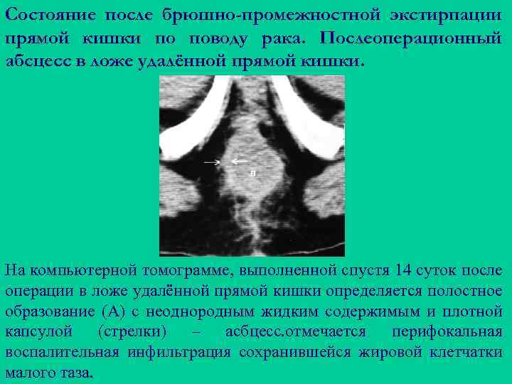 Состояние после брюшно-промежностной экстирпации прямой кишки по поводу рака. Послеоперационный абсцесс в ложе удалённой