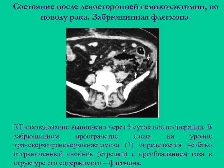 Состояние после левосторонней гемиколэктомии, по поводу рака. Забрюшинная флегмона. КТ-исследование выполнено через 5 суток