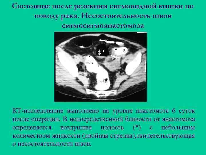 Состояние после резекции сигмовидной кишки по поводу рака. Несостоятельность швов сигмоанастомоза КТ-исследование выполнено на