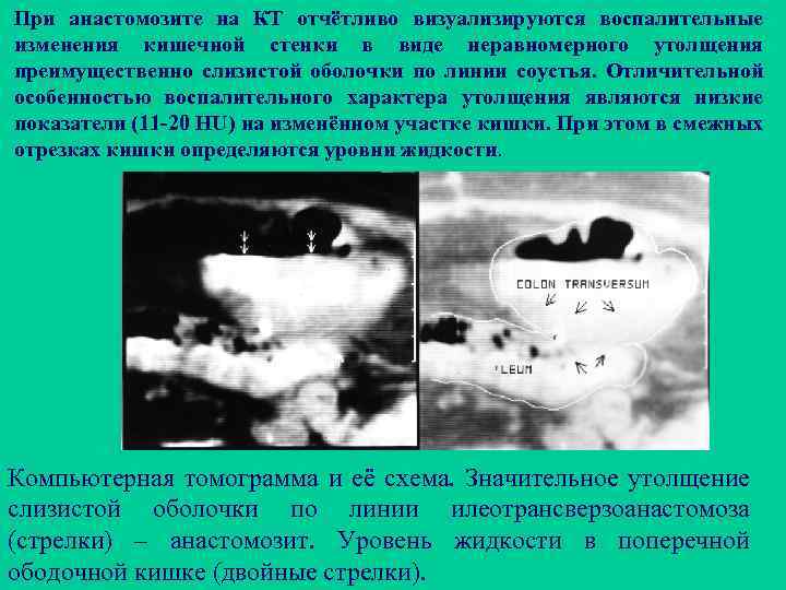 При анастомозите на КТ отчётливо визуализируются воспалительные изменения кишечной стенки в виде неравномерного утолщения