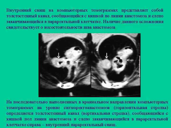 Внутренний свищ на компьютерных томограммах представляет собой толстостенный канал, сообщающийся с кишкой по линии