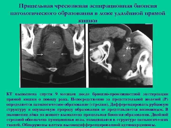 Прицельная чрескожная аспирационная биопсия патологического образования в ложе удалённой прямой кишки КТ выполнена спустя