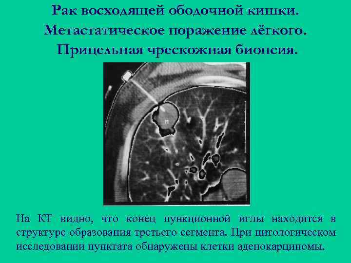 Рак восходящей ободочной кишки. Метастатическое поражение лёгкого. Прицельная чрескожная биопсия. На КТ видно, что
