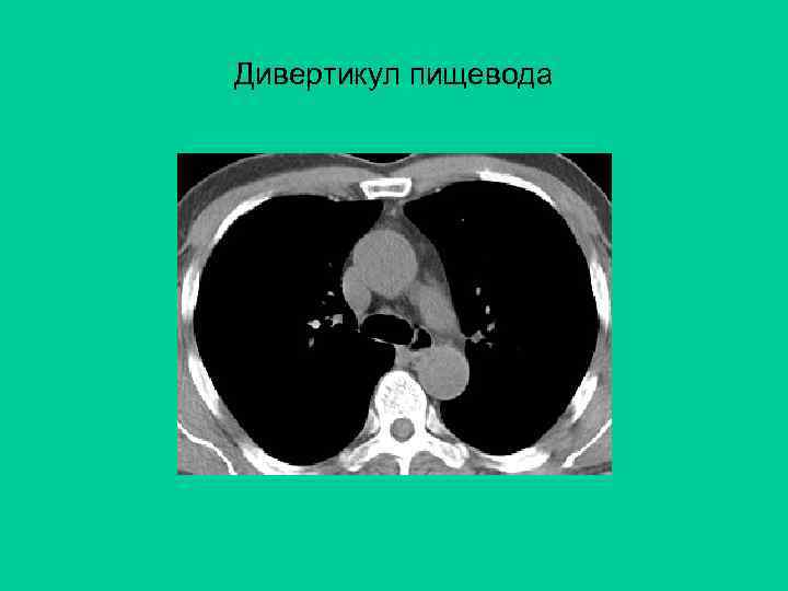 Дивертикул пищевода 