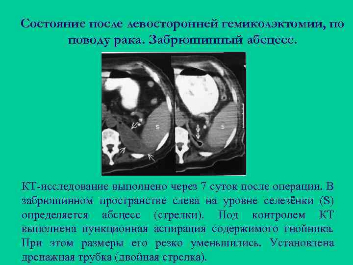 Состояние после левосторонней гемиколэктомии, по поводу рака. Забрюшинный абсцесс. КТ-исследование выполнено через 7 суток