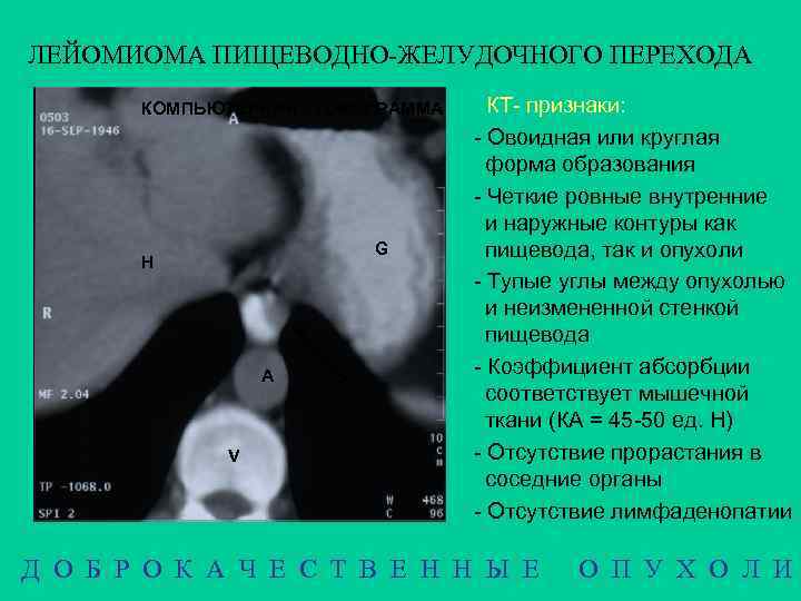 ЛЕЙОМИОМА ПИЩЕВОДНО-ЖЕЛУДОЧНОГО ПЕРЕХОДА КОМПЬЮТЕРНАЯ ТОМОГРАММА G H А V КТ- признаки: - Овоидная или
