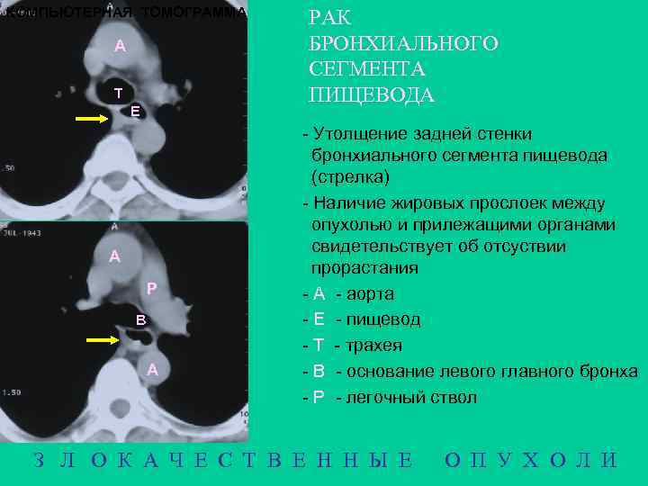 Сегменты пищевода по бромбару схема