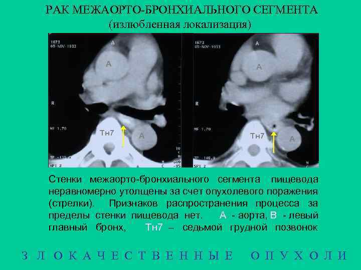 РАК МЕЖАОРТО-БРОНХИАЛЬНОГО СЕГМЕНТА (излюбленная локализация) А А B Тн 7 B А Тн 7